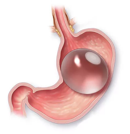 Gastric Balloon: An alternative for obesity treatment